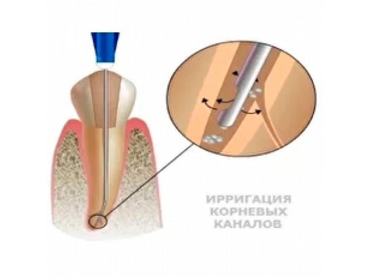 Эндодонтический шприц 30G (0,3х25) SitekMed Эндодонтический шприц 30G (0,3х25) SitekMed