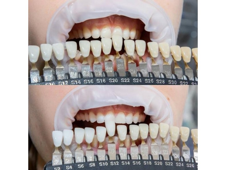 Амазинг Вайт 38% - Amazing White Premium Teeth Whitening Kit