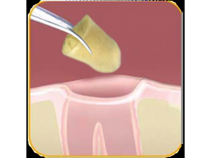 Микротупферы конусные коллагеновые 12х8 мм