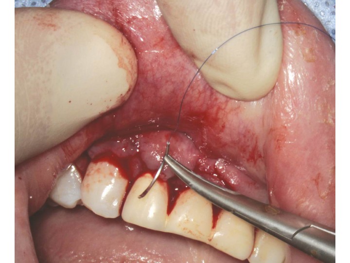 Иглодержатель MS-150, прямой с замком, 32003