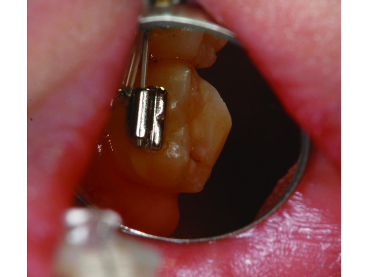 Кусачки EVER Fine 606S T/C, 27606