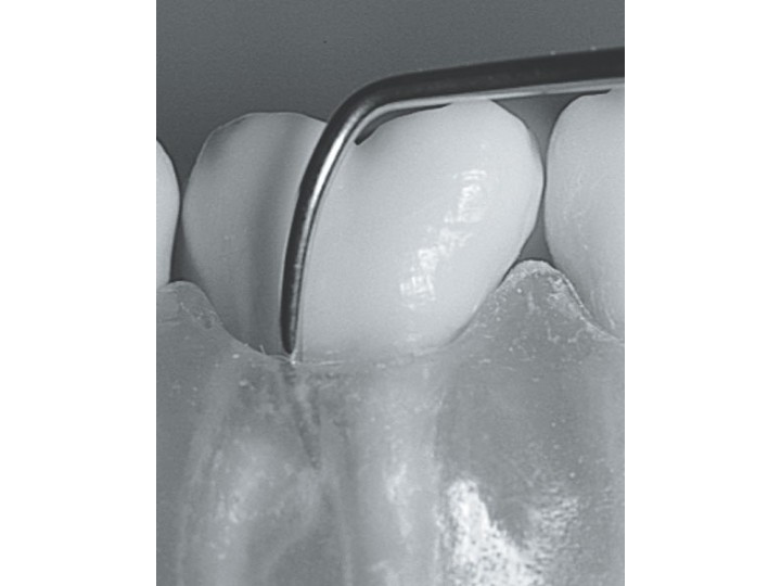 Зонд для обследования области фуркации корней Nabers Probe 20-21 LM 20-21