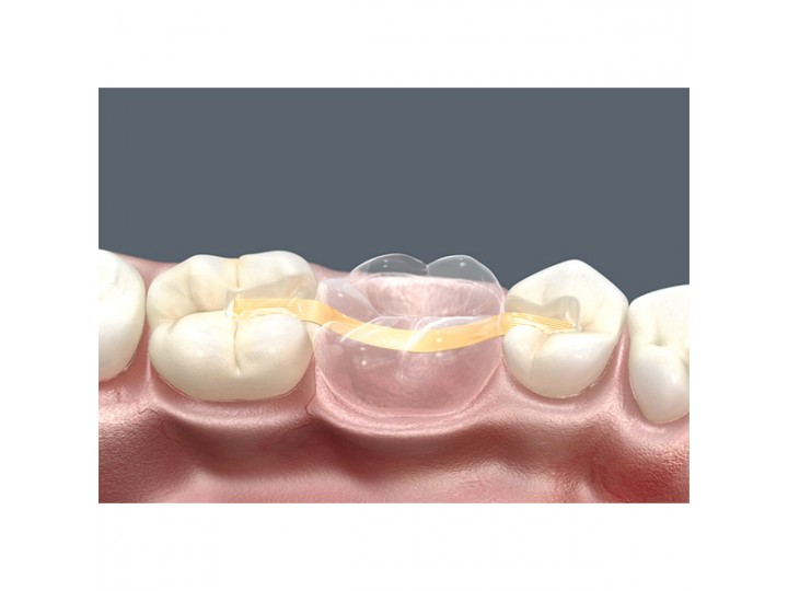 Шинирующая лента Dentapreg Bridge PFU - Дентапрег