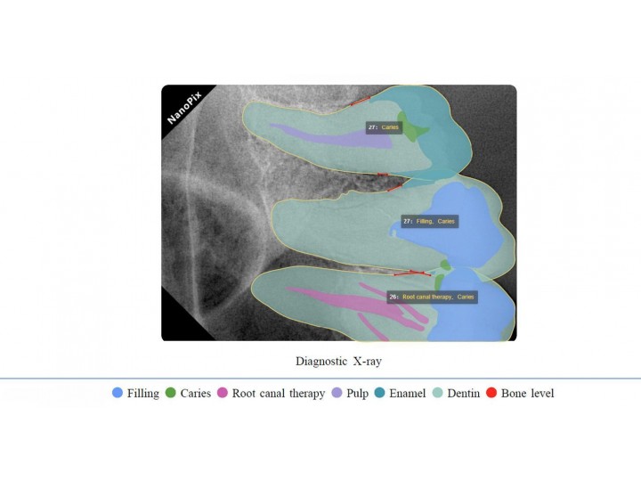 Комплект: портативный рентген HyperLight + визиограф NANOPIX 2, Eighteeth
