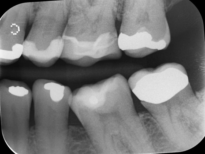 Набор Центион - Cention N Starter Kit