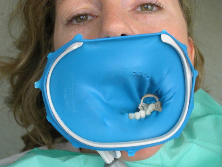 Набор оптиДам Постериор 5200 - OptiDam Posterior Intro Kit