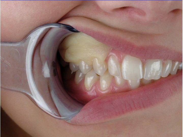 Ресо-Пак - Reso-Pac 5 шт х 25 г