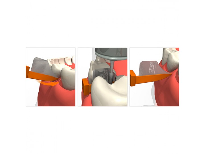 Клинья с матрицей FenderWedge