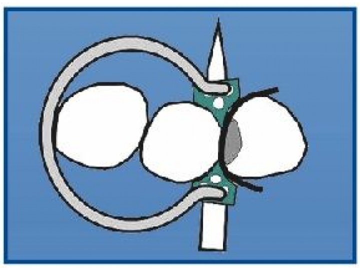 Кольцо фиксирующее 1.299