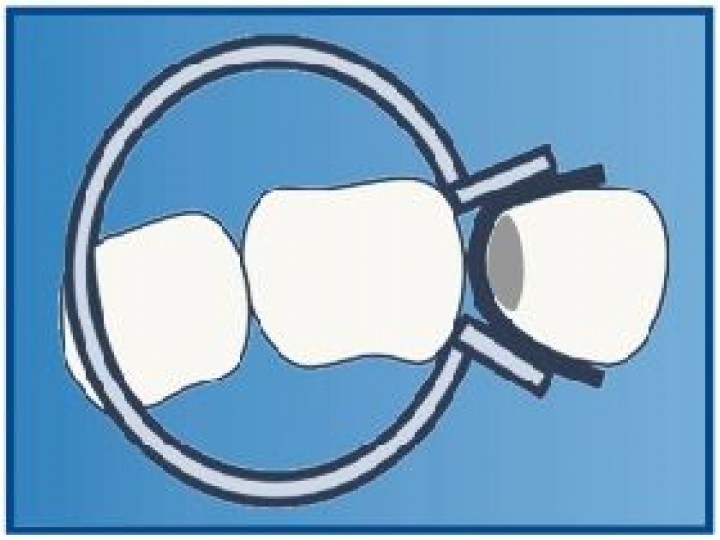 Кольцо фиксирующее "M" ТОР-1.177