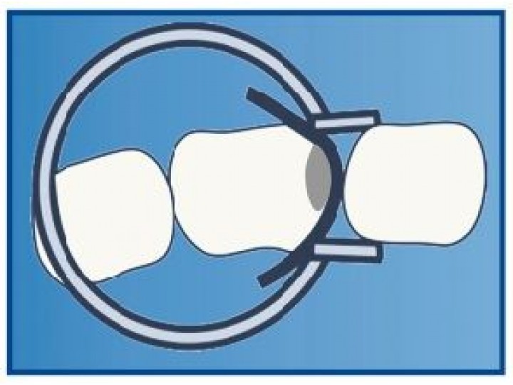 Кольцо фиксирующее 1.199