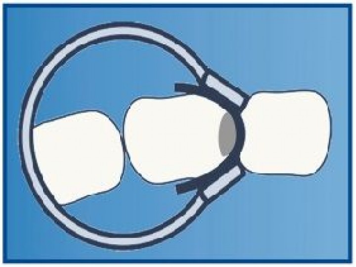 Кольцо фиксирующее 1.166