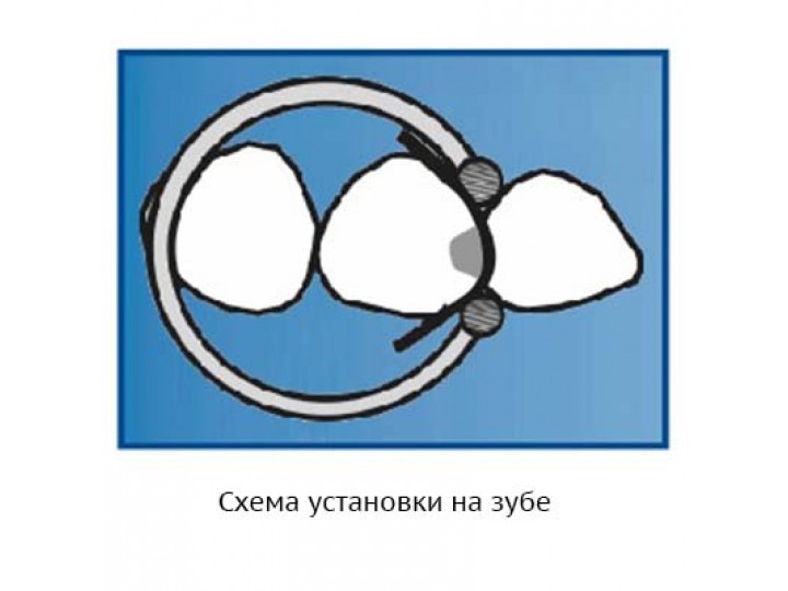 Кольцо фиксирующее 1.099, низкая ножка (4 мм)