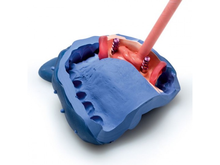 Десневая маска Гингифаст - Gingifast Rigid